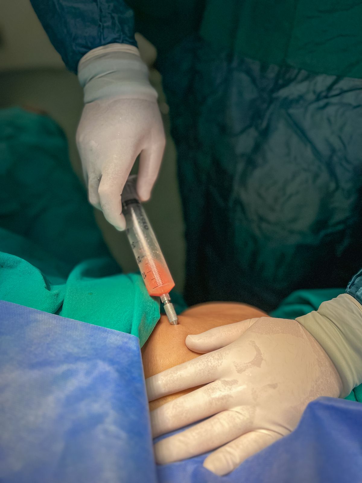 Médecin réalisant une injection locale d'ozone